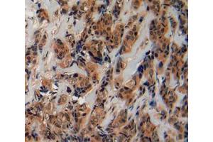 IHC-P analysis of breast cancer tissue, with DAB staining.