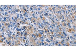Immunohistochemistry of paraffin-embedded Human liver cancer tissue using RICTOR Polyclonal Antibody at dilution 1:50 (RICTOR antibody)