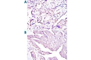 Immunohistochemical analysis of paraffin-embedded human placenta tissues (A) and ovarian cancer (B) using E7 monoclonal antibody, clone 6F3  with DAB staining. (HPV16 E7 antibody)