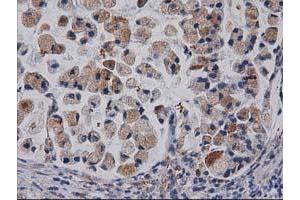 Immunohistochemical staining of paraffin-embedded Adenocarcinoma of Human colon tissue using anti-CDCP1 mouse monoclonal antibody.
