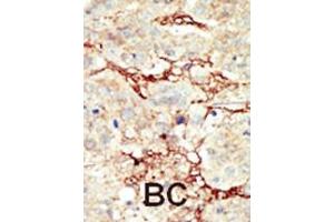 Formalin-fixed and paraffin-embedded human cancer tissue reacted with the primary antibody, which was peroxidase-conjugated to the secondary antibody, followed by DAB staining. (FGFR3 antibody  (C-Term))