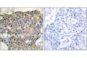 Immunohistochemistry analysis of paraffin-embedded human breast carcinoma, using EGFR (Phospho-Tyr1016) Antibody.