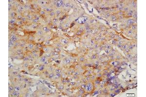paraformaldehyde-fixed, paraffin embedded human lung carcinoma tissue; Antigen retrieval by boiling in sodium citrate buffer(pH6) for 15min; Block endogenous peroxidase by 3% hydrogen peroxide for 30 minutes; Blocking buffer (normal goat serum) at 37°C for 20min; Antibody incubation with Rabbit Anti-CD168 Polyclonal Antibody, Unconjugated  at 1:200 overnight at 4°C, followed by a conjugated secondary and DAB staining (HMMR antibody  (AA 51-150))