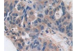 Detection of ARRb1 in Human Breast cancer Tissue using Polyclonal Antibody to Arrestin Beta 1 (ARRb1)