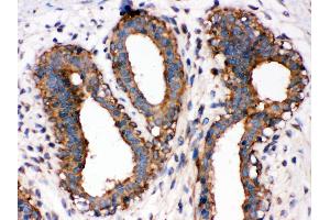 Anti-NF-kB p65 antibody, IHC(P) IHC(P): Human Mammary Cancer Tissue (NF-kB p65 antibody  (Middle Region))
