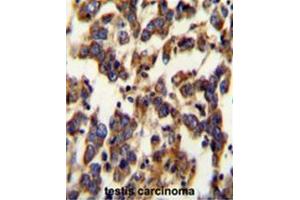 BSCL2 Antibody (N-term) immunohistochemistry analysis in formalin fixed and paraffin embedded human testis carcinoma followed by peroxidase conjugation of the secondary antibody and DAB staining. (BSCL2 antibody  (N-Term))