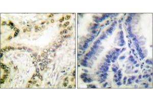 Immunohistochemistry analysis of paraffin-embedded human lung carcinoma tissue, using Histone H3 (Acetyl-Lys18) Antibody. (Histone 3 antibody  (H3K18ac))