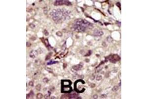 Formalin-fixed and paraffin-embedded human cancer tissue reacted with BTK polyclonal antibody  , which was peroxidase-conjugated to the secondary antibody, followed by DAB staining. (BTK antibody  (AA 209-239))