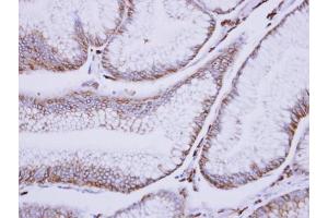 IHC-P Image Immunohistochemical analysis of paraffin-embedded human gastric cancer, using C1s, antibody at 1:500 dilution. (C1S antibody)