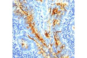 Immunohistochemical staining (Formalin-fixed paraffin-embedded sections) of human colon cancer with tag-72 monoclonal antibody, clone SPM536 .