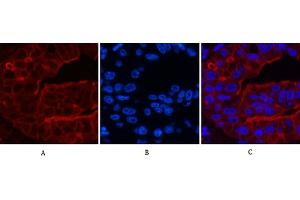 Immunofluorescence analysis of human liver cancer tissue. (ABCB5 antibody)