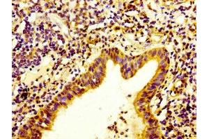 IHC image of ABIN7156434 diluted at 1:400 and staining in paraffin-embedded human lung cancer performed on a Leica BondTM system. (ITGA3 antibody  (AA 168-276))