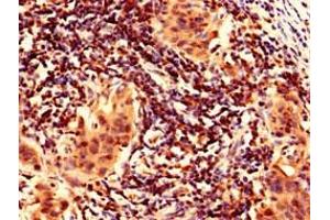 Immunohistochemistry analysis of human bladder cancer using ABIN7165446 at dilution of 1:100
