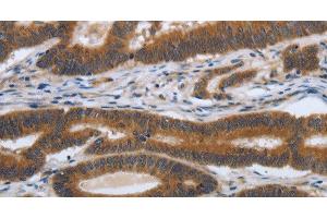 Immunohistochemistry of paraffin-embedded Human colon cancer tissue using PDGFA Polyclonal Antibody at dilution 1:70 (PDGFA antibody)