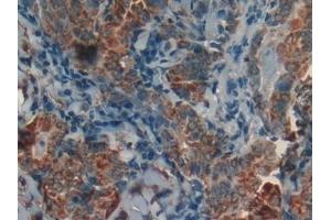 Detection of PHB in Human Thyroid cancer Tissue using Polyclonal Antibody to Prohibitin (PHB)