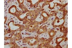 IHC image of ABIN7154988 diluted at 1:300 and staining in paraffin-embedded human liver cancer performed on a Leica BondTM system. (HBG2 antibody  (AA 2-147))