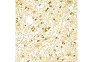 Immunohistochemistry of paraffin-embedded human brain cancer using TBL1XR1 antibody (ABIN5975754) at dilution of 1/100 (40x lens). (TBL1XR1 antibody)