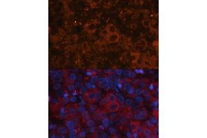 Immunofluorescence analysis of human liver cancer using Alpha-Fetoprotein (Alpha-Fetoprotein (AFP)) antibody (ABIN6129175, ABIN6136616, ABIN6136618 and ABIN6215038) at dilution of 1:100. (alpha Fetoprotein antibody  (AA 360-609))