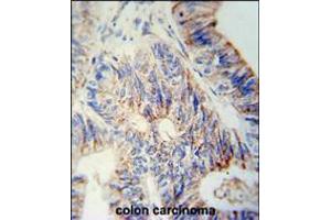 B3GNT6 Antibody immunohistochemistry analysis in formalin fixed and paraffin embedded human colon carcinoma followed by peroxidase conjugation of the secondary antibody and DAB staining. (B3GNT6 antibody  (AA 146-173))