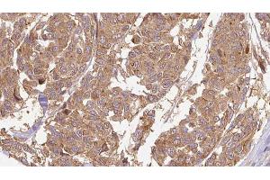 ABIN6274664 at 1/100 staining Human Melanoma tissue by IHC-P. (CYTL1 antibody)