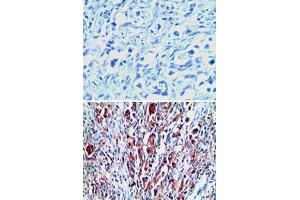 Immunohistochemical analysis of RXFP1 in paraffin-embedded formalin-fixed human stomach tumor tissue using an isotype control (top) and RXFP1 polyclonal antibody  (bottom) at 1 : 100. (RXFP1 antibody  (AA 694-732))