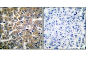 Immunohistochemistry analysis of paraffin-embedded human breast carcinoma tissue, using GR (Ab-211) Antibody. (GR (AA 181-230) antibody)