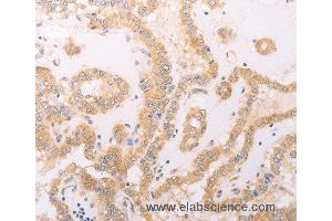 Immunohistochemistry of Human thyroid cancer using F7 Polyclonal Antibody at dilution of 1:40