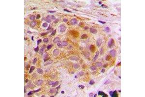 Immunohistochemical analysis of STAT5B staining in human breast cancer formalin fixed paraffin embedded tissue section. (STAT5B antibody)