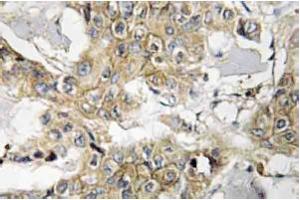 Immunohistochemistry analyzes of HER2 antibody in paraffin-embedded human breast carcinoma tissue. (ErbB2/Her2 antibody)