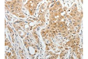 The image on the left is immunohistochemistry of paraffin-embedded Human lung cancer tissue using ABIN7192952(TTF2 Antibody) at dilution 1/5, on the right is treated with synthetic peptide. (TTF2 antibody)