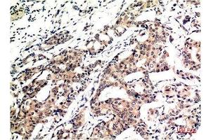 Immunohistochemical analysis of paraffin-embedded Human Breast Carcinoma Tissue using Ubiquitin Mouse mAb diluted at 1:200. (Ubiquitin antibody)