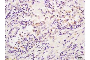 Formalin-fixed and paraffin embedded human colon carcinoma labeled with Anti-CD19 Polyclonal Antibody, Unconjugated (ABIN1387313) at 1:200 followed by conjugation to the secondary antibody and DAB staining. (CD19 antibody  (AA 151-250))