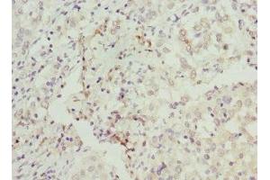 Immunohistochemistry of paraffin-embedded human lung cancer using ABIN7145588 at dilution of 1:100 (BAAT antibody  (AA 309-418))