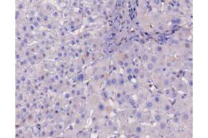 ABIN6267226 at 1/200 staining human liver cancer tissue sections by IHC-P. (IKBKB antibody  (pTyr188))