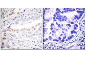 Immunohistochemistry analysis of paraffin-embedded human lung carcinoma tissue using Uba2 antibody. (UBA2 antibody  (C-Term))