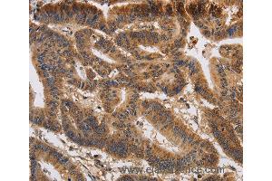 Immunohistochemistry of Human colon cancer using KCNK9 Polyclonal Antibody at dilution of 1:40