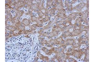 IHC-P Image Immunohistochemical analysis of paraffin-embedded human hepatoma, using IL13 Receptor alpha 1, antibody at 1:500 dilution. (IL13 Receptor alpha 1 antibody)