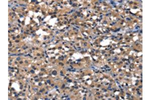 The image on the left is immunohistochemistry of paraffin-embedded Human thyroid cancer tissue using ABIN7129820(IGFBP5 Antibody) at dilution 1/25, on the right is treated with fusion protein.