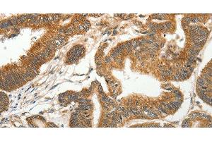 Immunohistochemistry of paraffin-embedded Human colon cancer tissue using SLC4A4 Polyclonal Antibody at dilution 1:50 (SLC4A4 antibody)