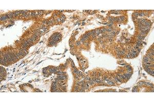Immunohistochemistry of paraffin-embedded Human colon cancer tissue using SLC4A4 Polyclonal Antibody at dilution 1:50