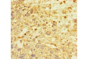 Immunohistochemistry of paraffin-embedded human melanoma using ABIN7172513 at dilution of 1:100 (E2F1 antibody  (AA 133-362))