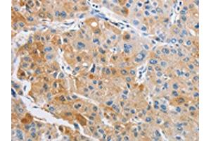 The image on the left is immunohistochemistry of paraffin-embedded Human liver cancer tissue using ABIN7128493(ARHGAP5 Antibody) at dilution 1/25, on the right is treated with fusion protein. (ARHGAP5 antibody)