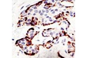 IHC analysis of FFPE human breast carcinoma tissue stained with the SUV39H2 antibody (SUV39H2 antibody  (AA 93-122))