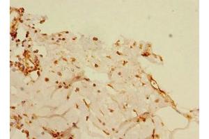 Immunohistochemistry of paraffin-embedded human breast cancer using ABIN7145551 at dilution of 1:100 (BLID antibody  (AA 1-108))