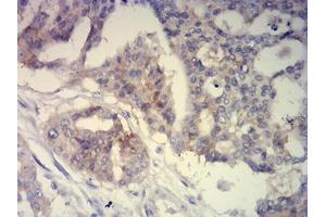 Immunohistochemical analysis of paraffin-embedded ovarian cancer tissues using CD239 mouse mAb with DAB staining. (BCAM antibody  (AA 32-197))