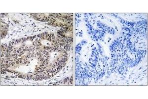 Immunohistochemistry analysis of paraffin-embedded human colon carcinoma tissue, using ZFYVE19 Antibody. (ZFYVE19 antibody  (AA 311-360))