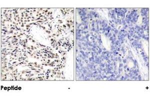 Immunohistochemical analysis of paraffin-embedded human breast carcinoma tissue using RELA polyclonal antibody . (NF-kB p65 antibody)