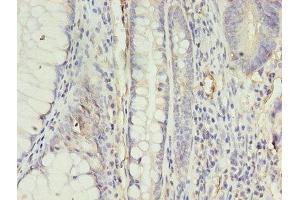 Immunohistochemistry of paraffin-embedded human colon cancer using ABIN7144394 at dilution of 1:100 (Apelin Receptor antibody  (AA 309-380))