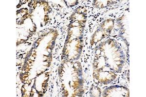IHC-P: Oncostatin M antibody testing of human intestinal cancer tissue