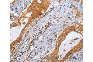 Immunohistochemistry of Human cervical cancer using CDK19 Polyclonal Antibody at dilution of 1:70 (CDK19 antibody)